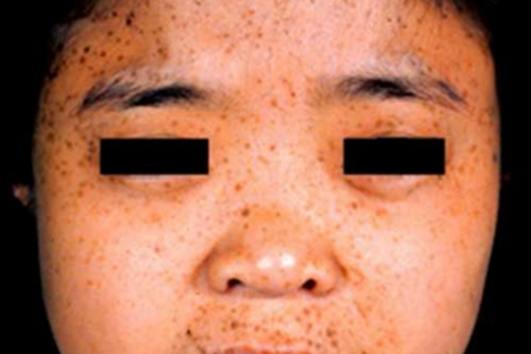 泛发性黑子病面部黑点图