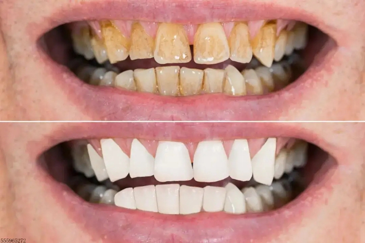 龈下刮治前后对比图 龈下刮治前后对比图