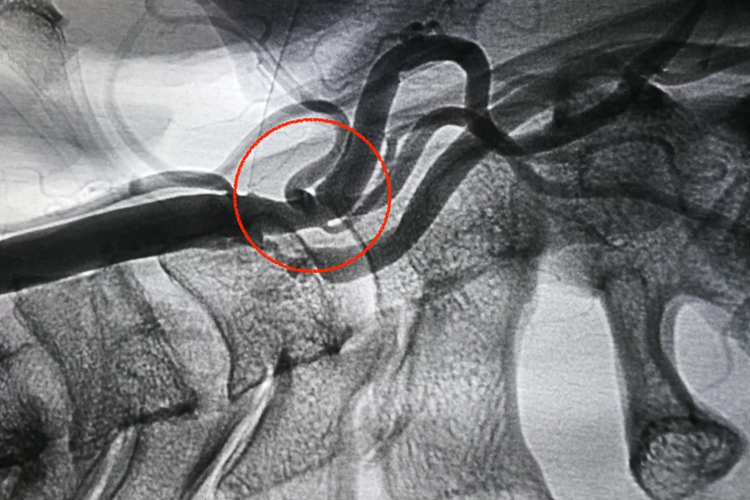 脑动脉斑块图 脑动脉斑块图