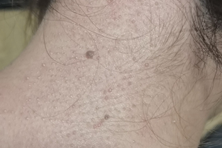 毛囊角化病后颈疙瘩图