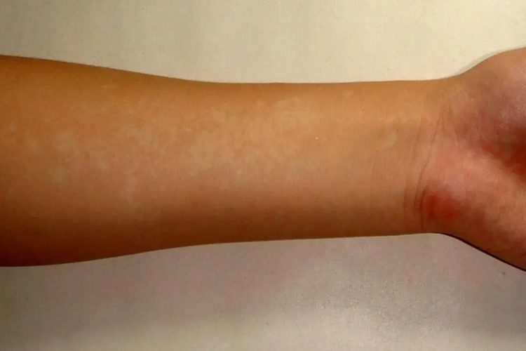 贫血痣图 贫血痣图