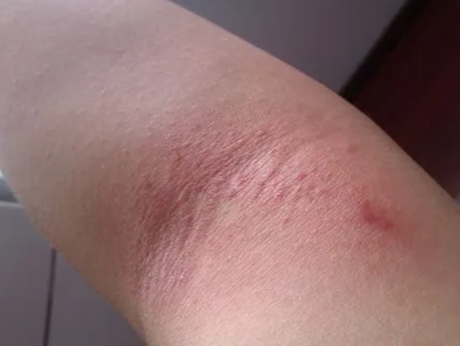 胳膊肘内侧湿疹图