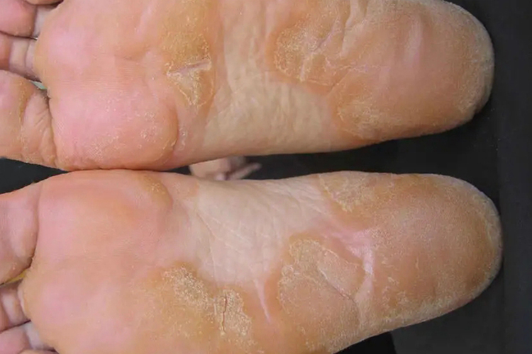 更年期角化病角化斑块图