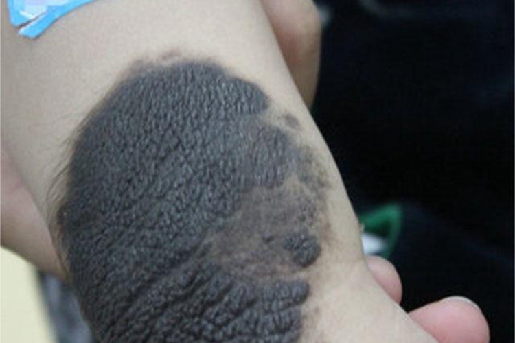 兽皮痣腿黑斑图