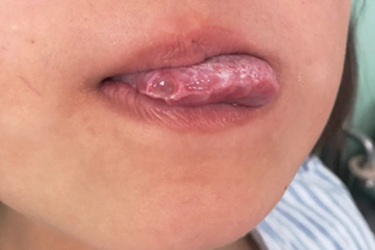 贝赫切特综合征舌侧症状图 贝赫切特综合征舌侧症状图