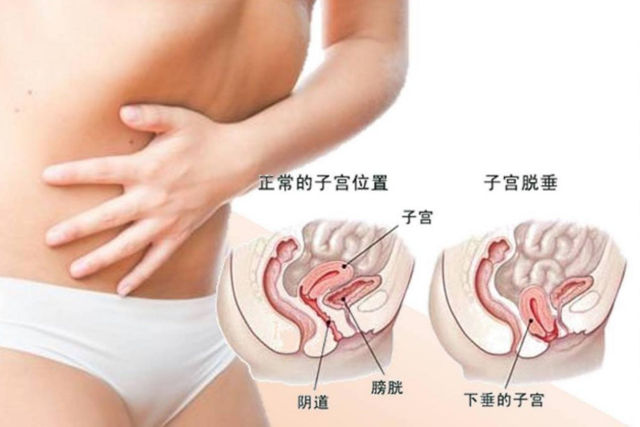 子宫正常位置与子宫脱垂对比图