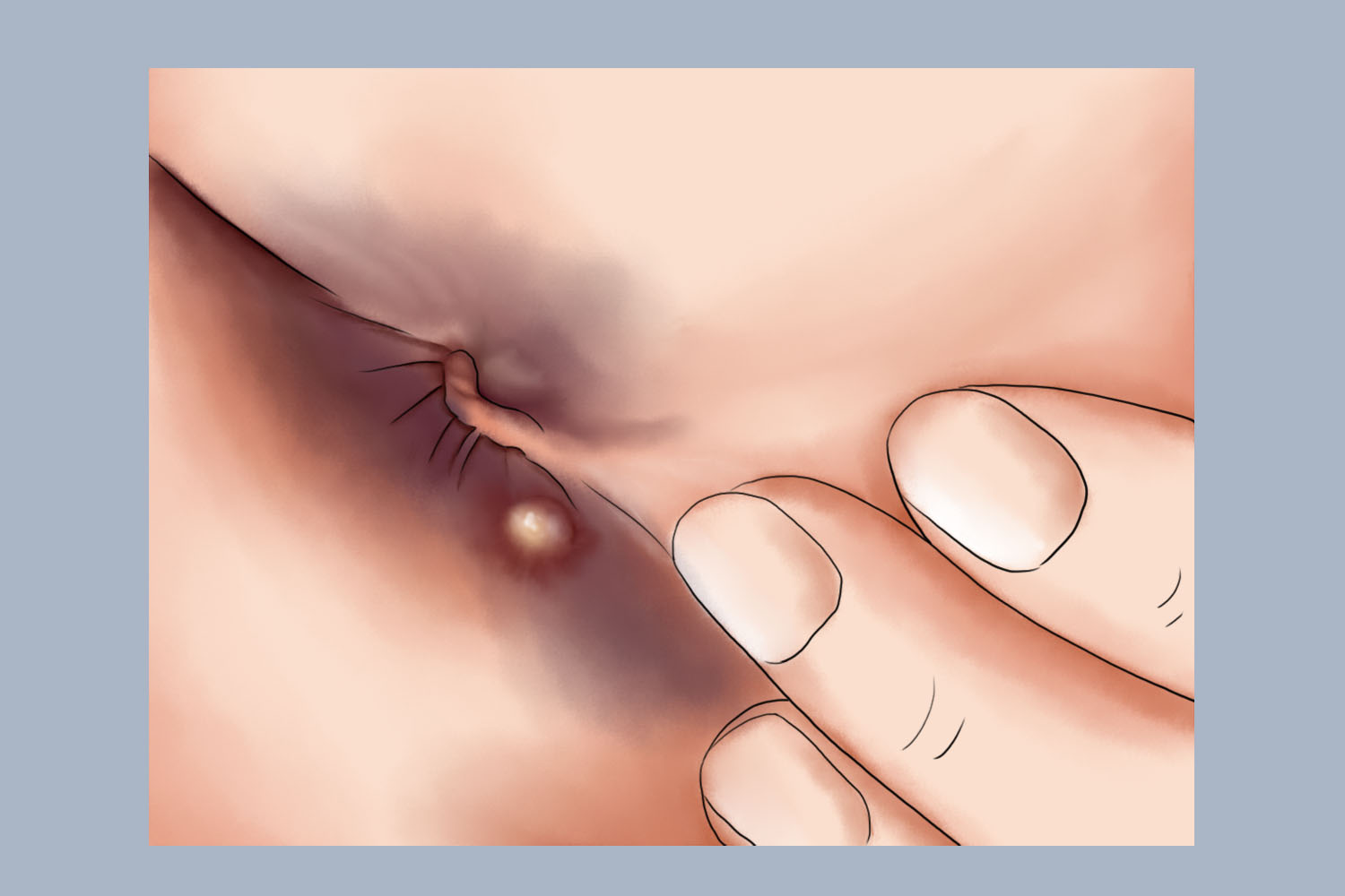 疖肿肛门下方长疙瘩图