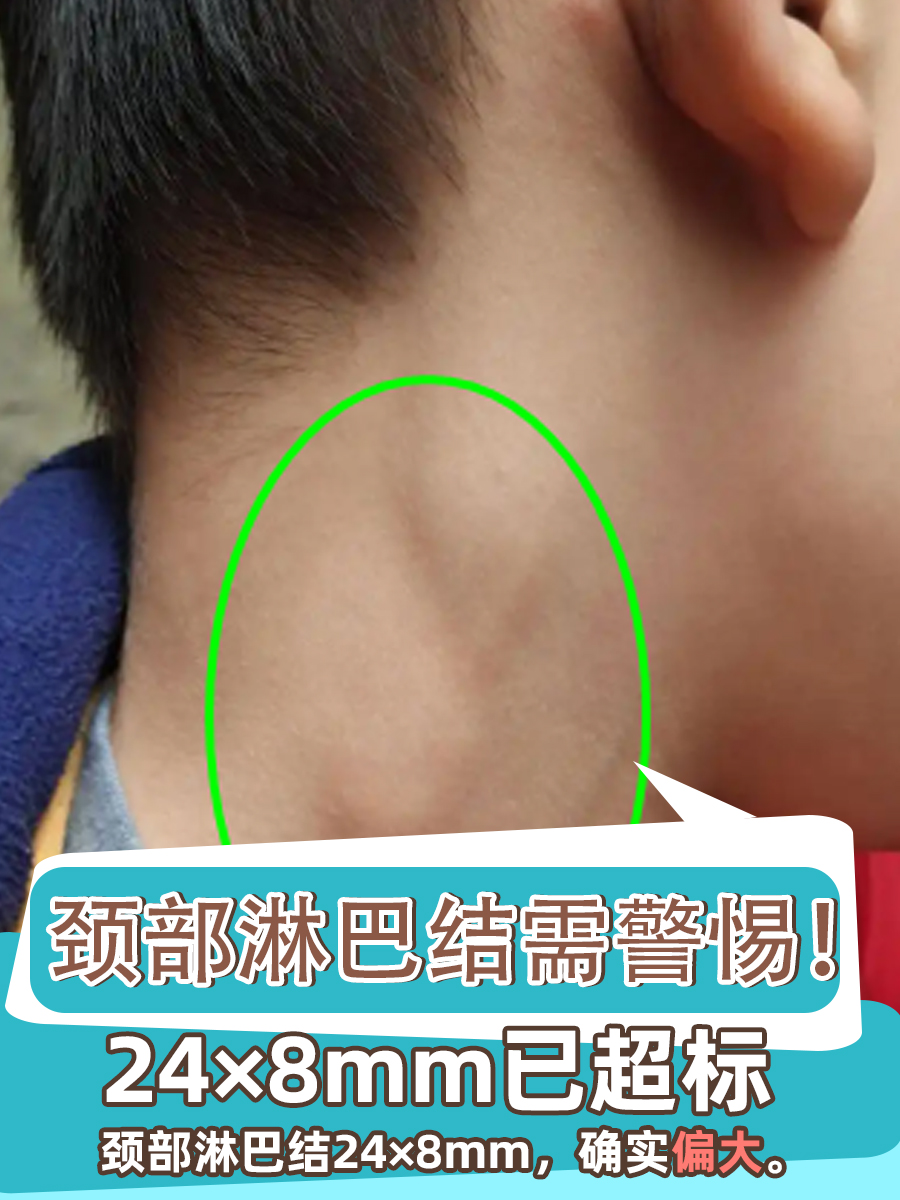 颈部淋巴结需警惕!24×8mm已超标