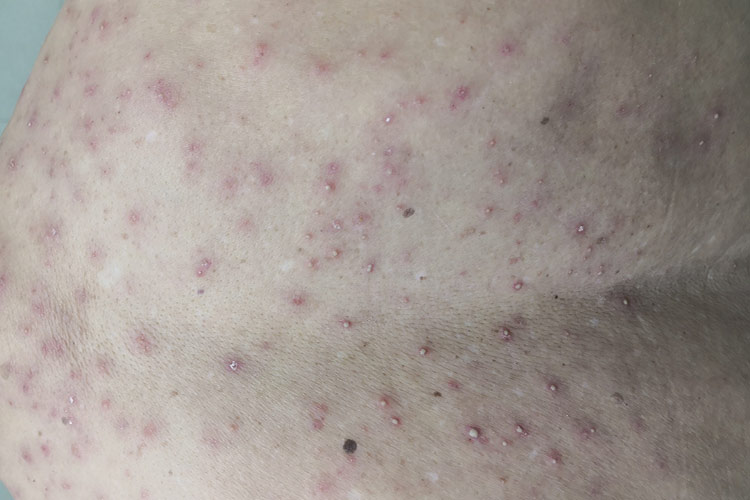 脓痱图 脓痱图