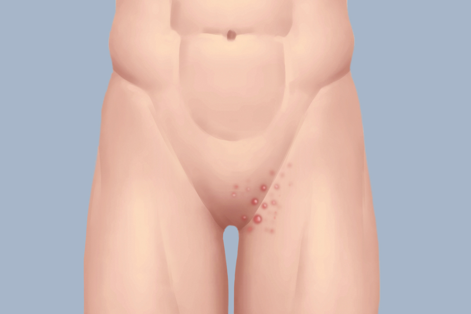 腹股沟毛囊炎图