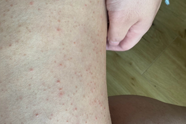 螨虫皮炎大腿疙瘩图