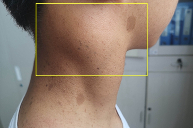 纤维肉瘤侧颈症状图