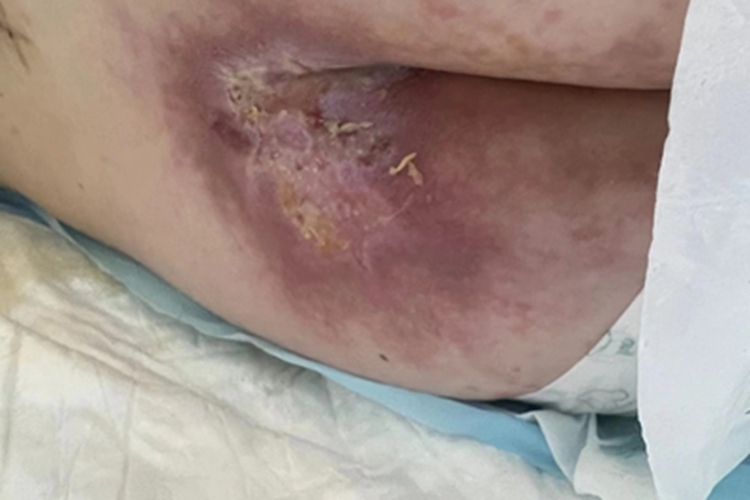 溃疡期压疮红斑图 溃疡期压疮红斑图