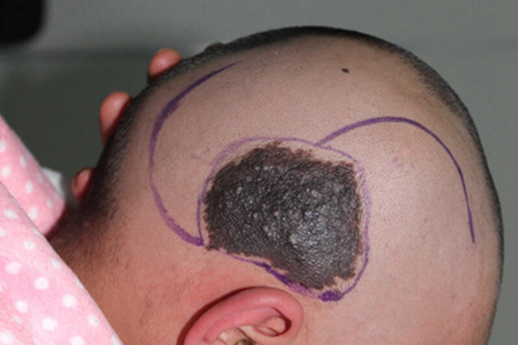 兽皮痣头部症状图 兽皮痣头部症状图