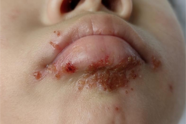 接触传染性脓疱疮嘴唇症状图