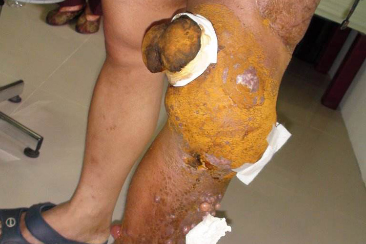 四肢横纹肌肉瘤图