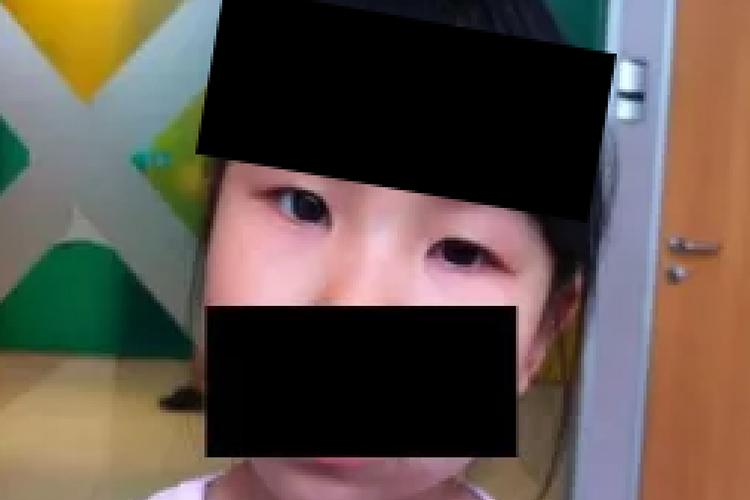 儿童轻度垂直斜视图 儿童轻度垂直斜视图