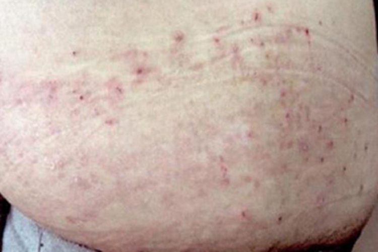 疱疹样皮炎腹部症状图 疱疹样皮炎腹部症状图