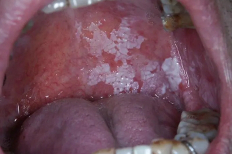 二期梅毒口腔症状图