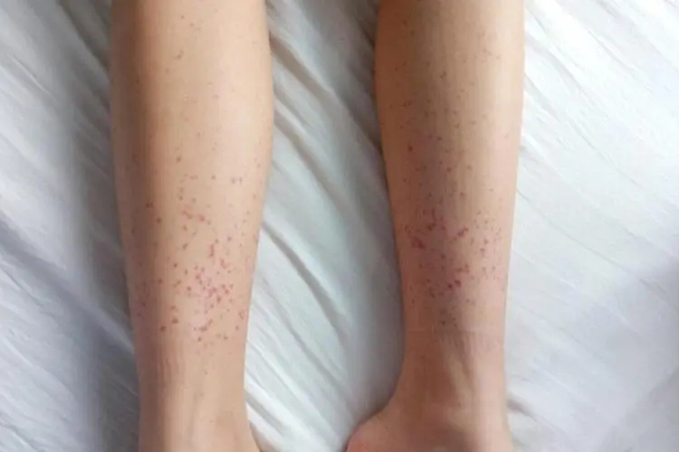 药物性血小板出血点图