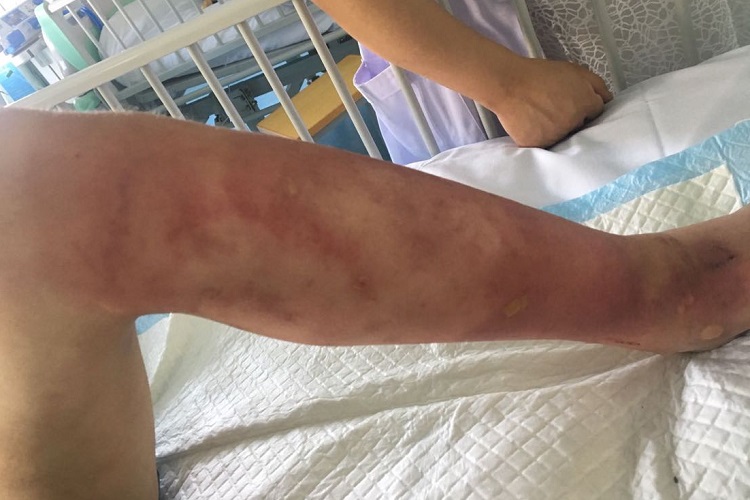 弥漫型类丹毒小腿症状图 弥漫型类丹毒小腿症状图