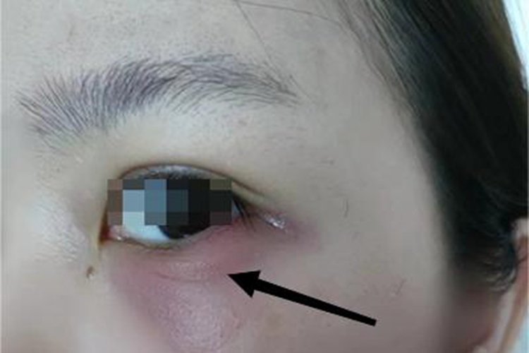 过敏性眼睑皮肤炎眼睑小疙瘩图