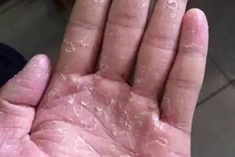 表皮松解性掌跖角皮症手掌脱皮图