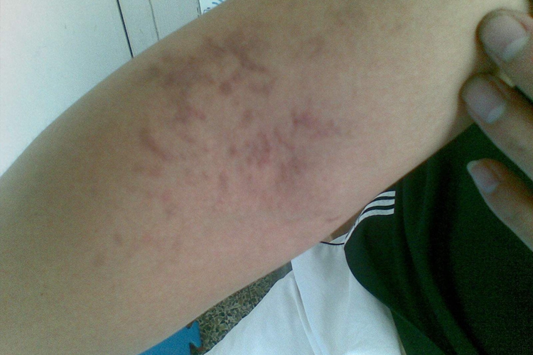 慢性湿疹图 慢性湿疹图