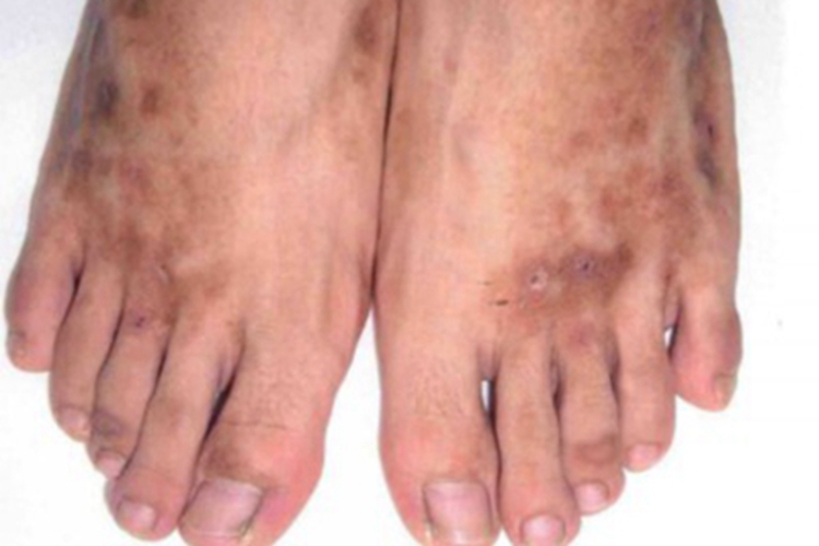 青斑性血管病脚背斑图 青斑性血管病脚背斑图