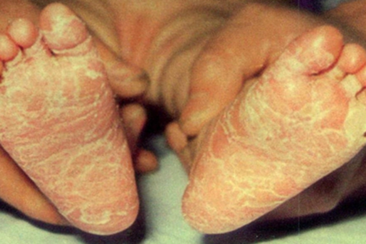 先天性梅毒脚底症状图