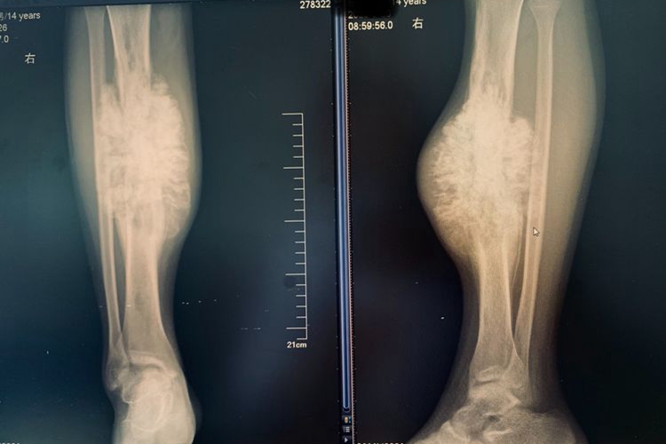 骨癌的骨头X线图