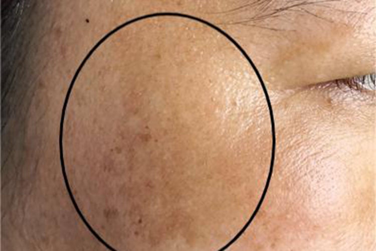黄褐斑症状图