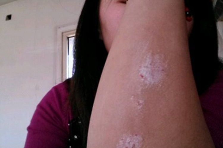 慢性湿疹初期症状图