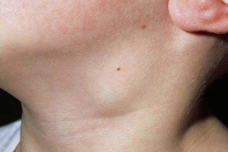 颈部淋巴结肿大图