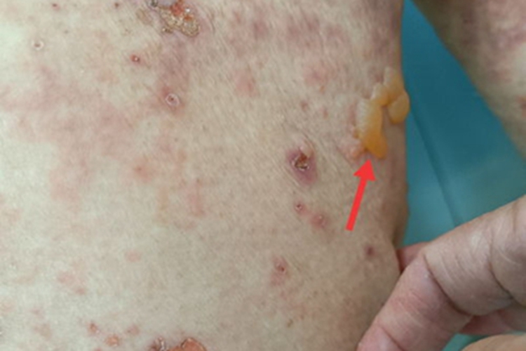 大疱性类天疱疮大腿症状图 大疱性类天疱疮大腿症状图