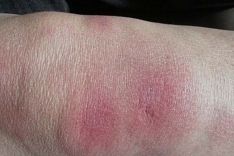 硬红斑腿上红色肿块图 硬红斑腿上红色肿块图