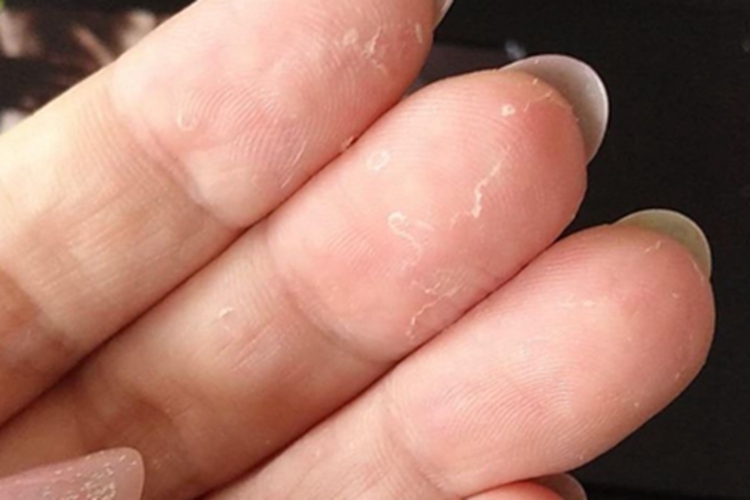 剥脱性角质松解症症状图