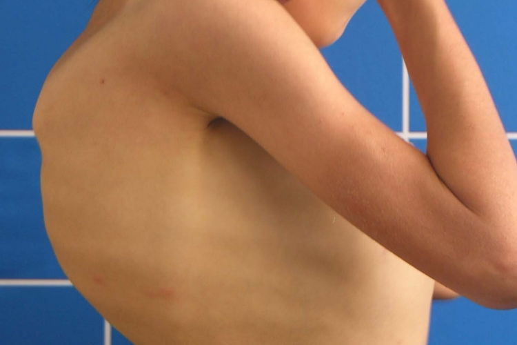 儿童脊柱侧弯图 儿童脊柱侧弯图