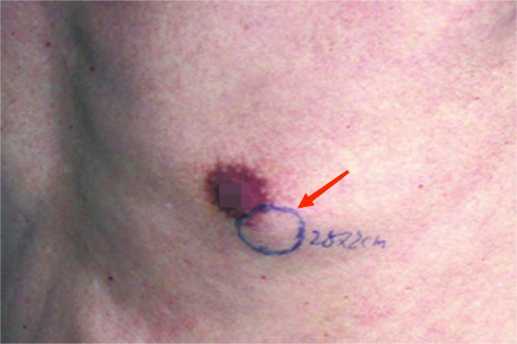 男性乳腺癌胸部症状图