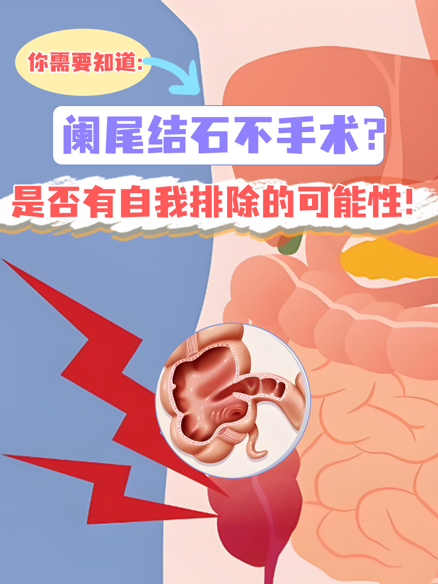 阑尾结石不手术？是否有自我排除的可能性！