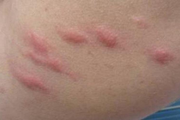 急性自发性荨麻疹红斑图