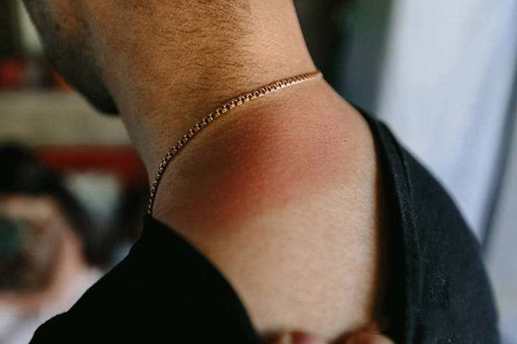 颈部日光性皮炎图