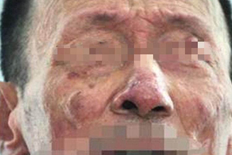 持久性隆起性红斑面部红斑图 持久性隆起性红斑面部红斑图