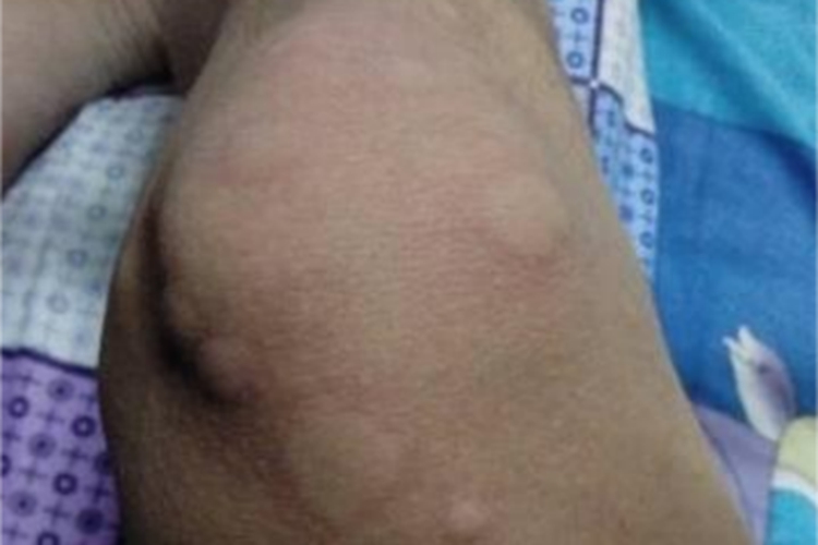 体虱病膝盖上很多风团图