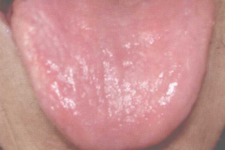 光滑舌图 光滑舌图