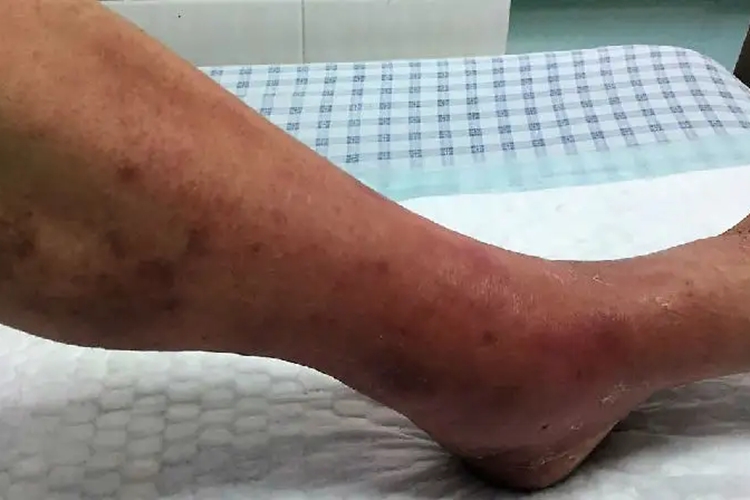 男人丹毒脚肿图 男人丹毒脚肿图