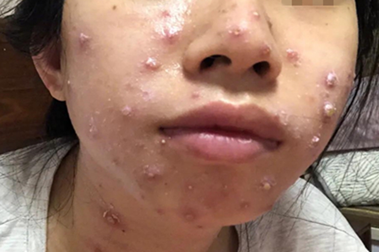 水痘脸上结好多痂图