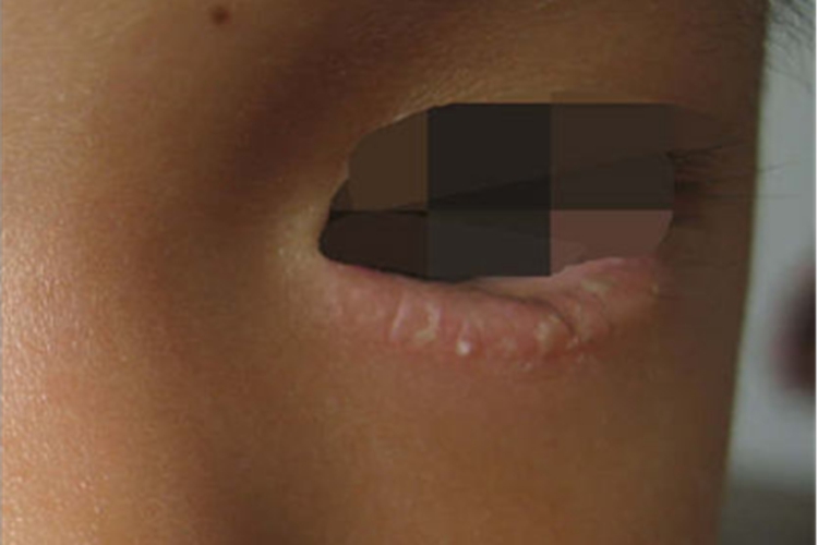 干燥型婴儿湿疹眼睑症状图