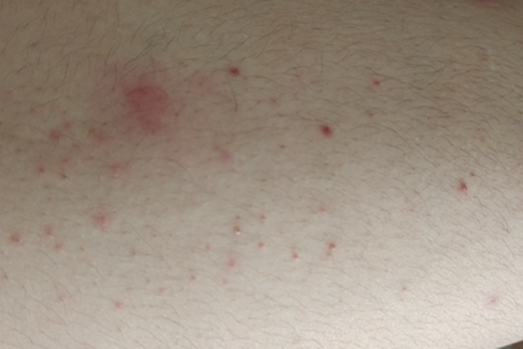 毛囊炎腿上长红疹子和疙瘩图