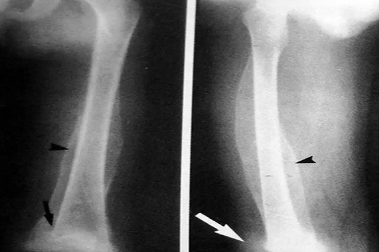 坏血病骨骼X线图 坏血病骨骼X线图